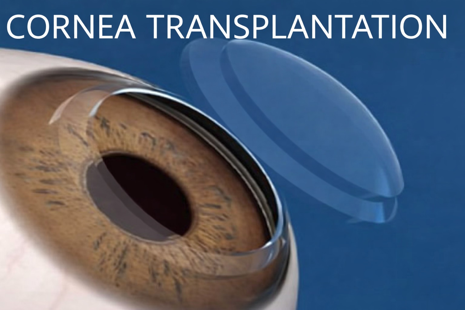 Cornea Transplantation