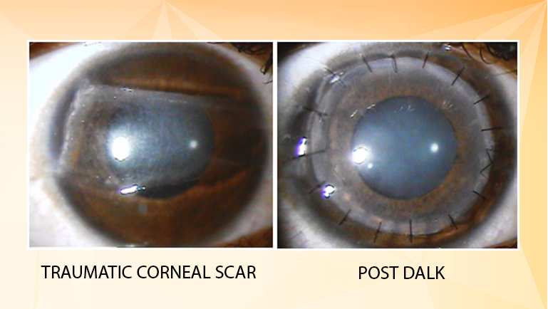 DALK (Deep Anterior Lamellar Keratoplasty)