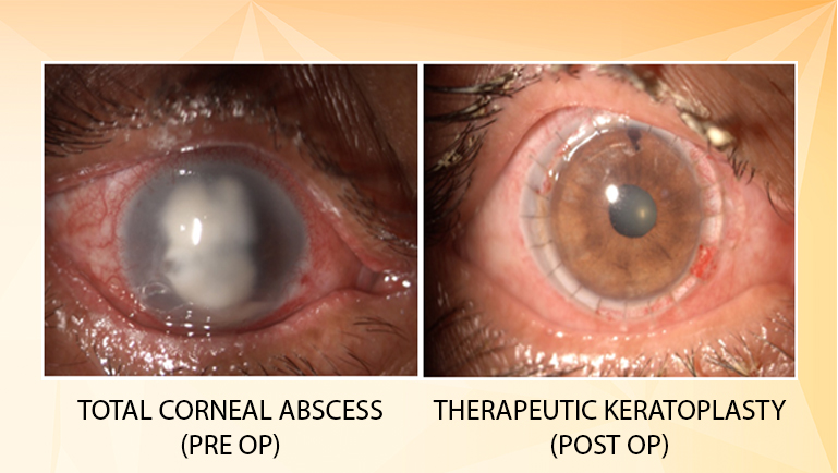 THPK (THERAPEUTIC KERATOPLASTY) 