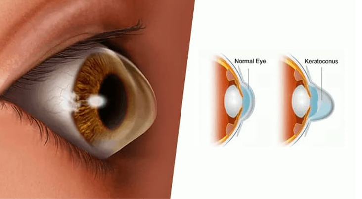 KERATOCONUS TREATMENT – C3R