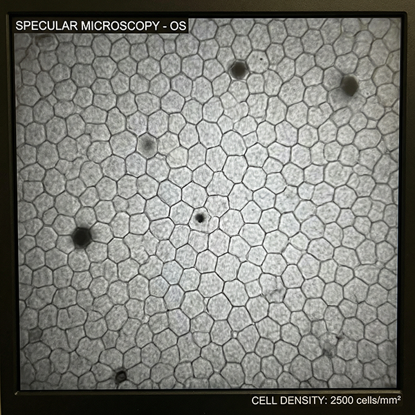 SPECULAR MICROSCOPY -  Advanced Diagnostic Device