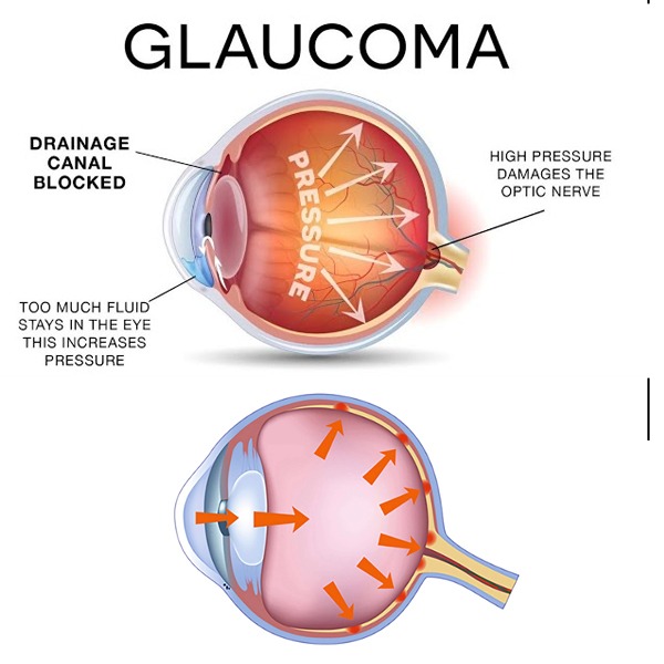 Glaucoma Surgery